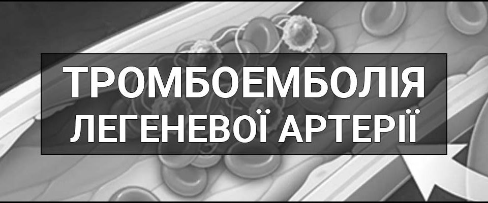 Тромбоемболія легеневої артерії (ТЕЛА) – що це таке, визначення, суть, симптоми, причини, профілактика та лікування.