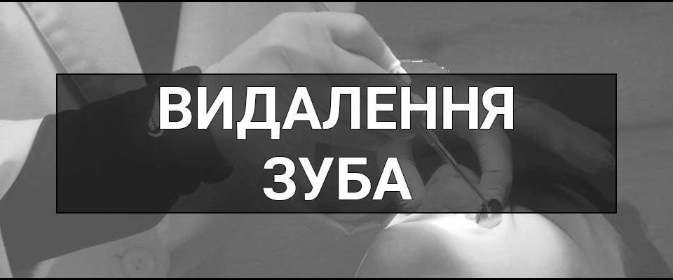 Видалення зуба – що це таке, визначення і суть, рекомендації та поради як уникнути ускладнень після видалення зуба.